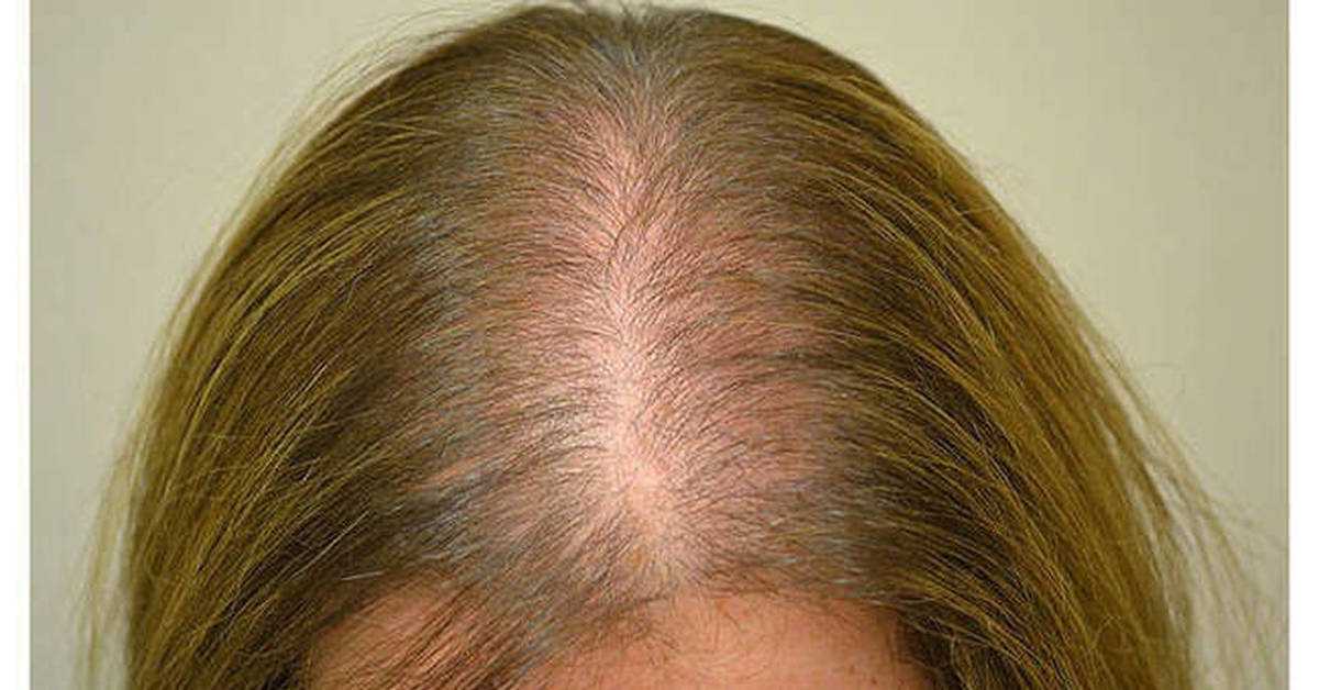 Причины выпадения волос после коронавируса